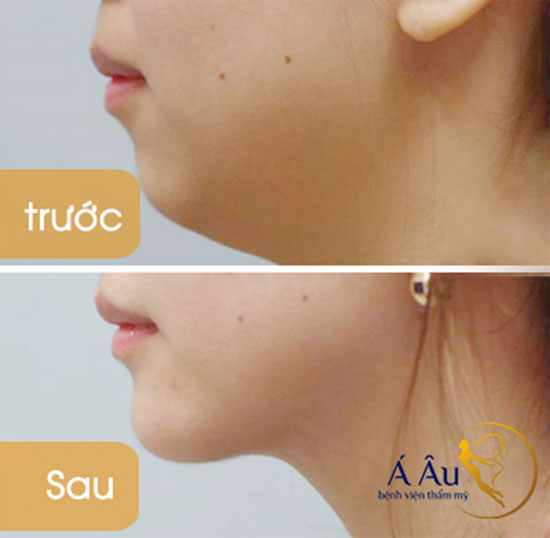 Hút mỡ cằm không phẫu thuật cho chị em cằm đôi, ngấn mỡ - hut mo nong cam khong phau thuat 2 1