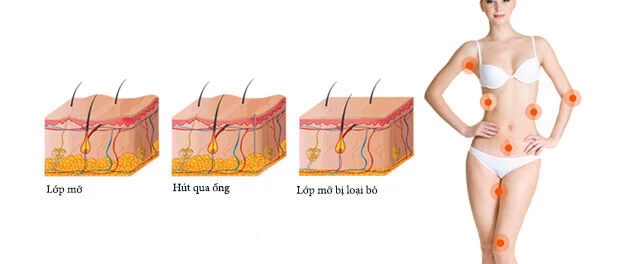 Hút mỡ toàn thân giá bao nhiêu tiền? - hut mo toan than gia