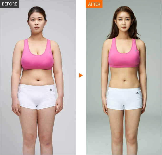 Hút mỡ toàn thân giá bao nhiêu tiền? - hut mo toan than gia..