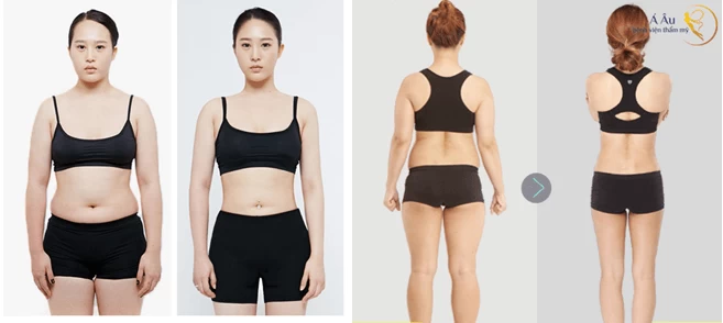 Hút mỡ ở bệnh viện 108 có hiệu quả không? - hut mo toan than