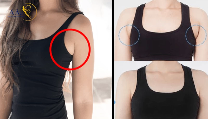 Trường hợp phù hợp hút mỡ vùng nách?