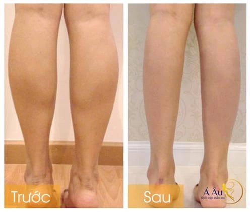 Kết quả điều trị giảm mở bắp chân