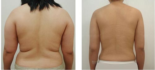 Hút mỡ bụng tại bệnh viện Thu Cúc có an toàn không? 12 Kết quả điều trị giảm mỡ lưng tại Bệnh viện thẩm mỹ Á Âu