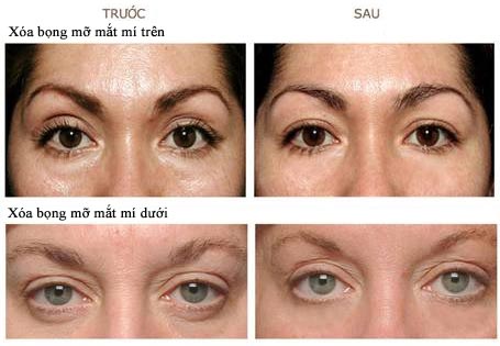 kết quả điều trị xóa bọng mỡ mắt