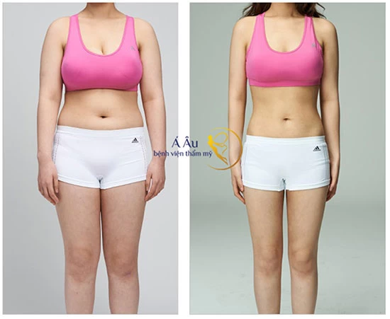 Kết quả đánh tan mỡ tích lũy tận 10 năm