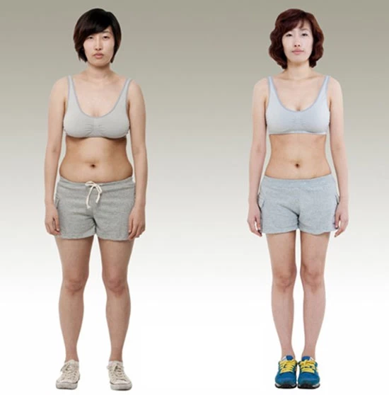Kết quả sau khi thực hiện hút mỡ bụng