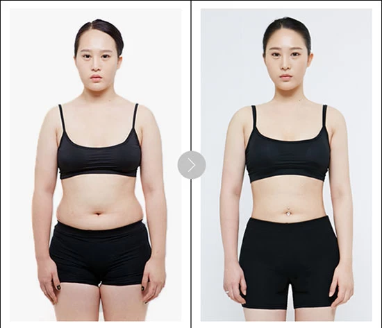 Hút mỡ ở đâu hoàn hảo hiện nay tại Việt Nam? - ket qua hut mo khong phau thuat 3