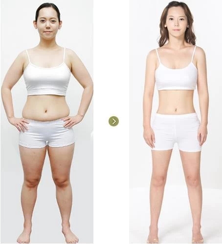 Sự bất ngờ kinh ngạc sau khi hút mỡ bụng