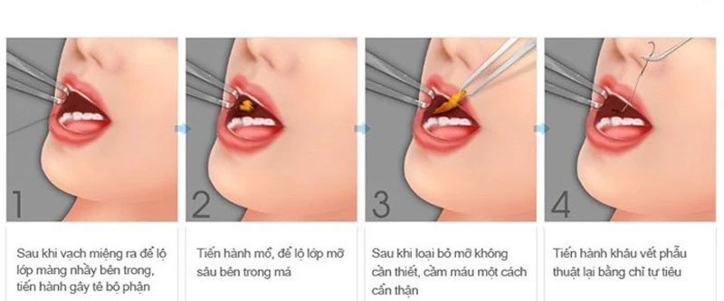 Hủy mỡ nọng cằm không phẫu thuật - lay mo ma 10