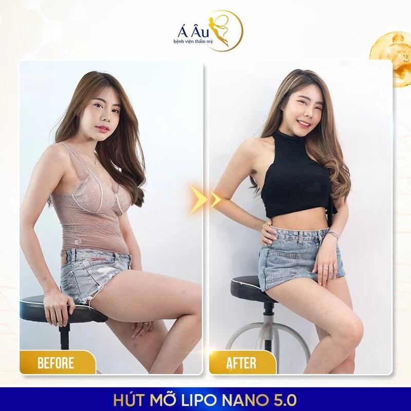 Hút mỡ bụng là gì? Công nghệ hút mỡ Lipo Nano 5.0 có khả năng làm giảm mỡ bụng lên đến 30cm