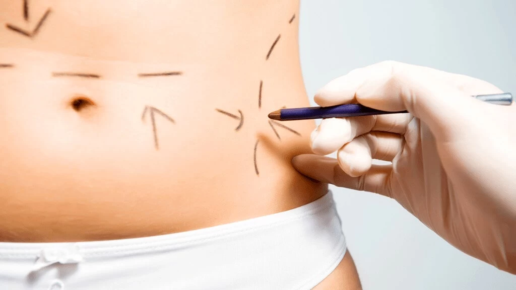 Hút mỡ eo bằng Pharaon Lipo rất an toàn