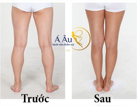 Mỡ thừa bắp chân nên khắc phục thế nào? - mo thua bap chan.