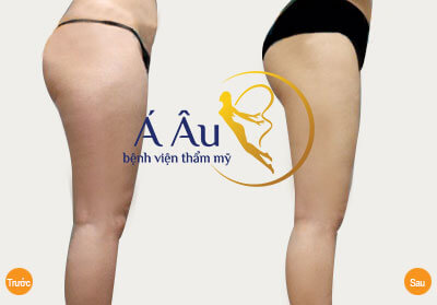 BVTM Á Âu chuyển giao công nghệ mới Pharaon Lipo