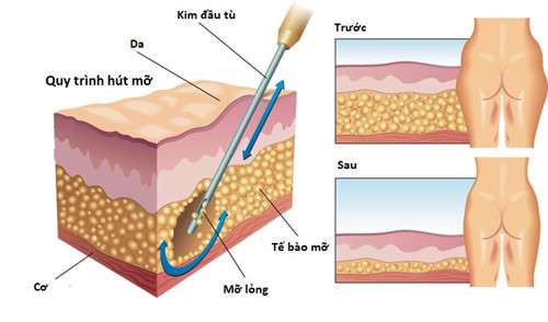 Hút mỡ không cần phẫu thuật