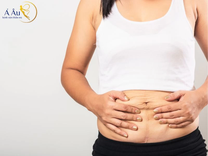 Tích tụ chất lỏng là hiện tượng thường thấy sau khi thực hiện hút mỡ bụng
