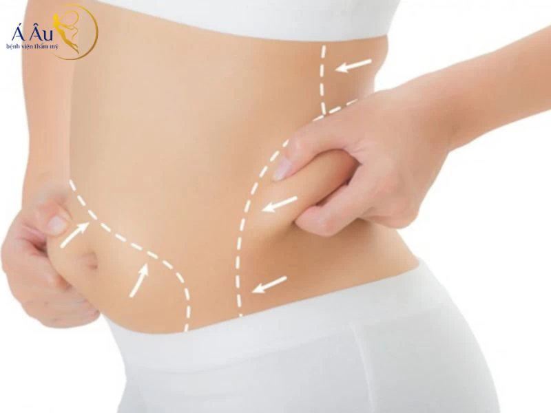 Chi phí hút mỡ bụng trên và mỡ bụng dưới có sự khác biệt rõ rệt