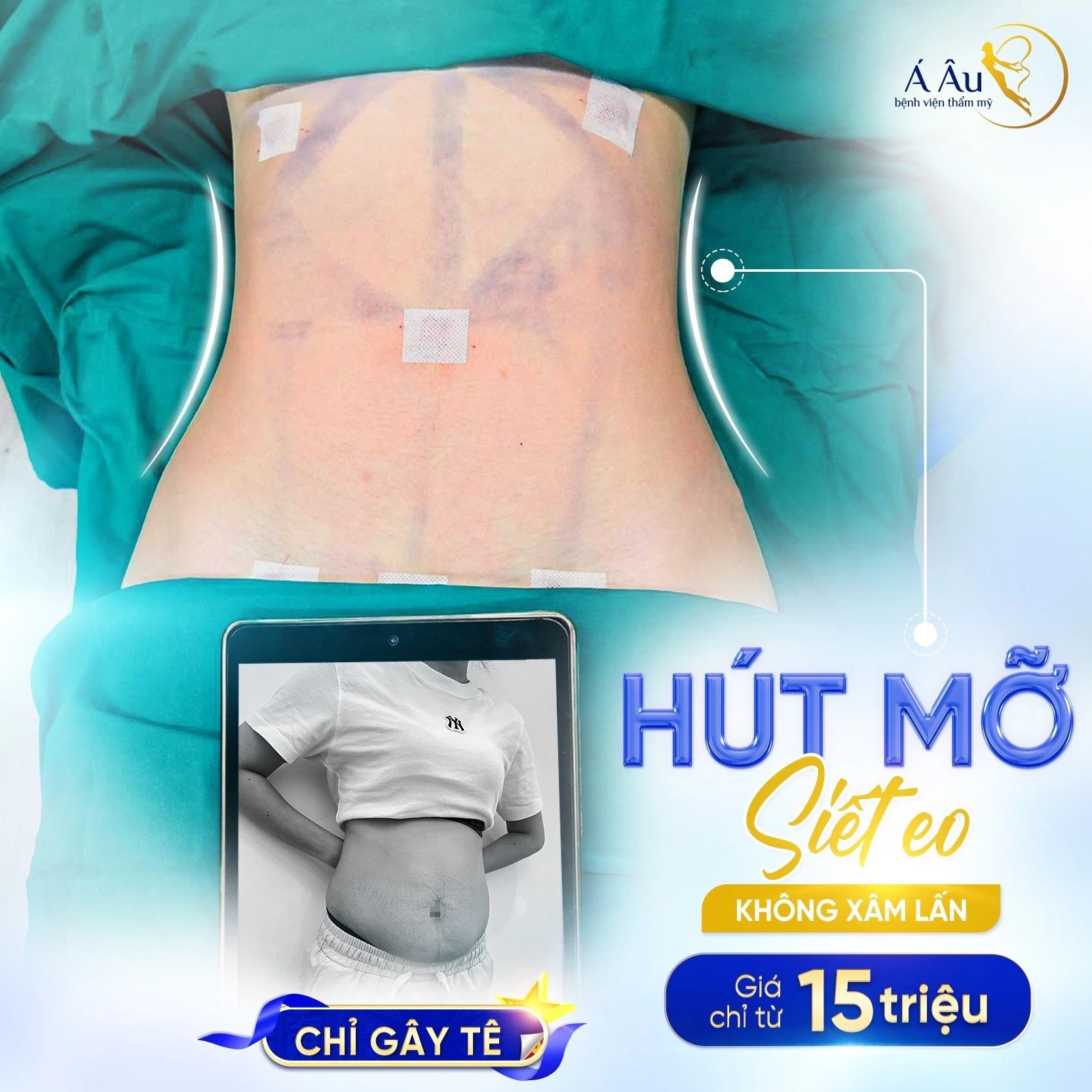 Hút mỡ bụng toàn phần Lipo Nano 5.0 bao nhiêu tiền?