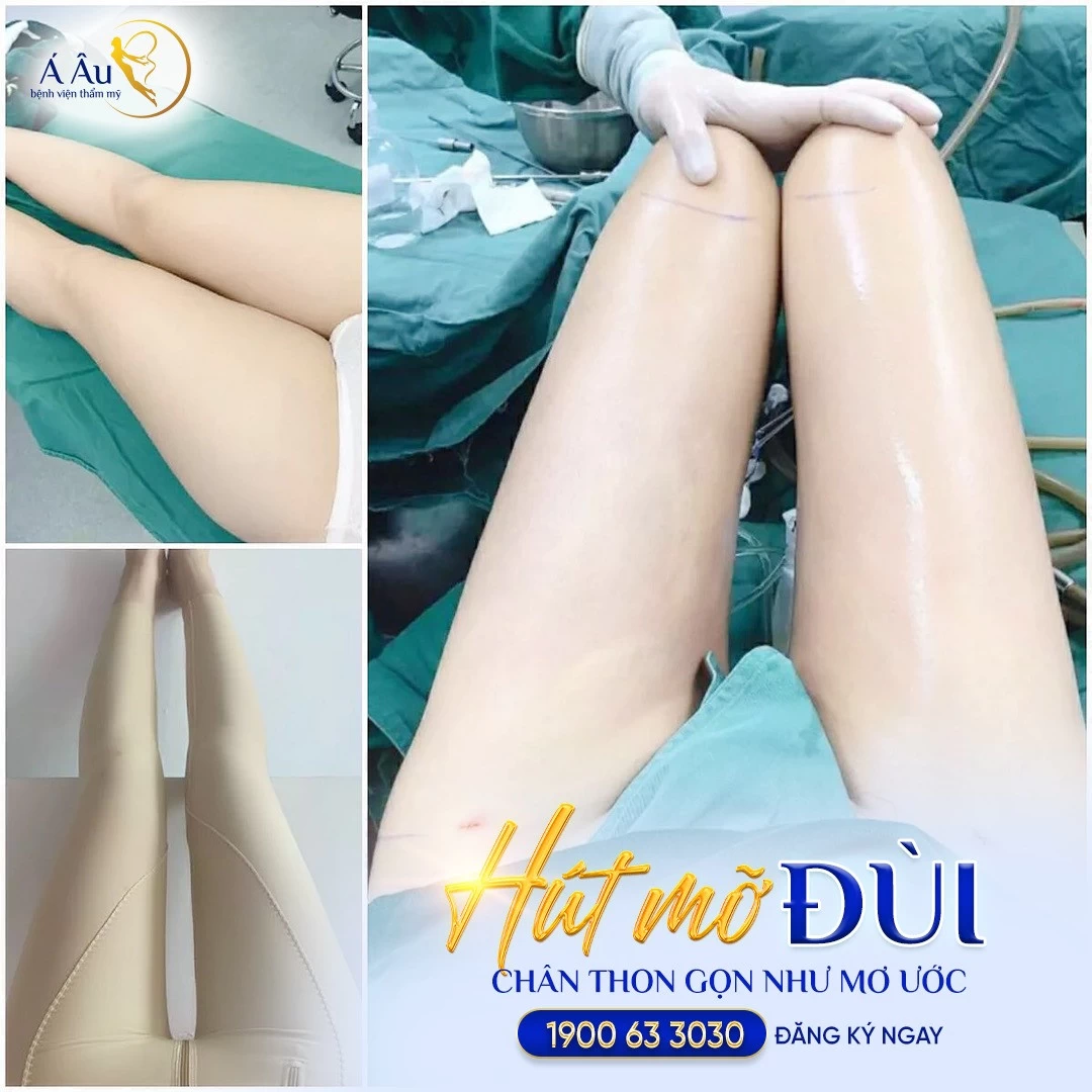 Thoát kiếp cánh tay "lực điền" sau 60 phút với công nghệ hủy mỡ không phẫu thuật Lipo Nano 5.0